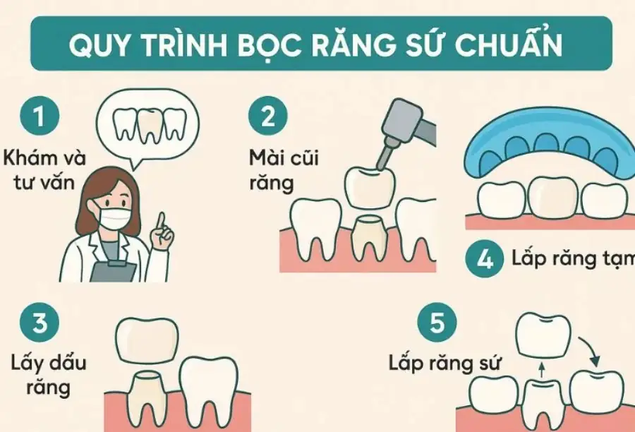 Quy trình chuẩn 6 bước bọc răng sứ Emax tại Paris