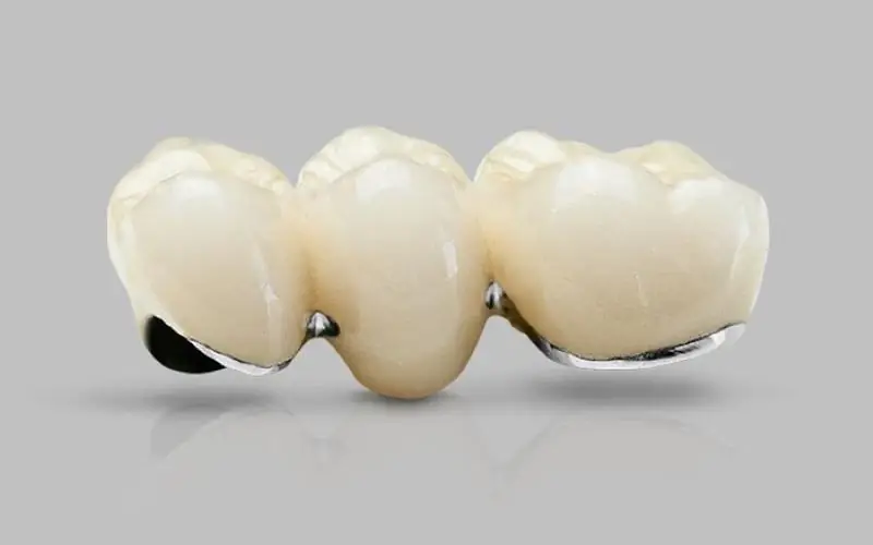 Răng sứ kim loại giá rẻ, phù hợp với nhiều đối tượng khách hàng
