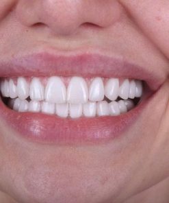 Răng sứ DDBio – Đức